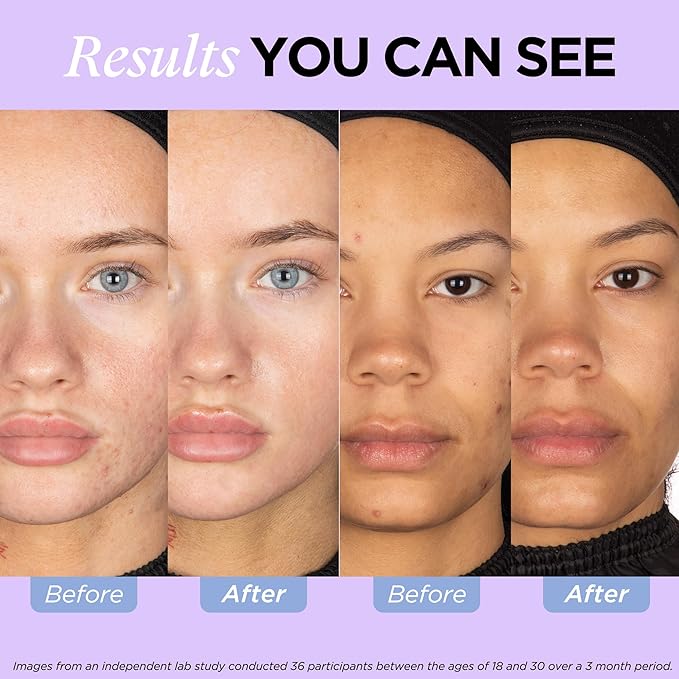 ZitSticka Vitamin Acne Supplement for Cystic Acne w/ 30 Natural Caps for Women and Men, Supplements for Hormonal Support, Skin Clarity, Dark Spots - Dermatologist Tested (After Hours Ceramides)